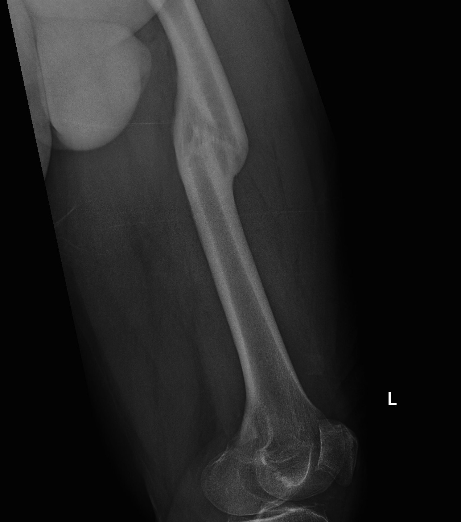 TKR Staged Osteotomy Preop 2